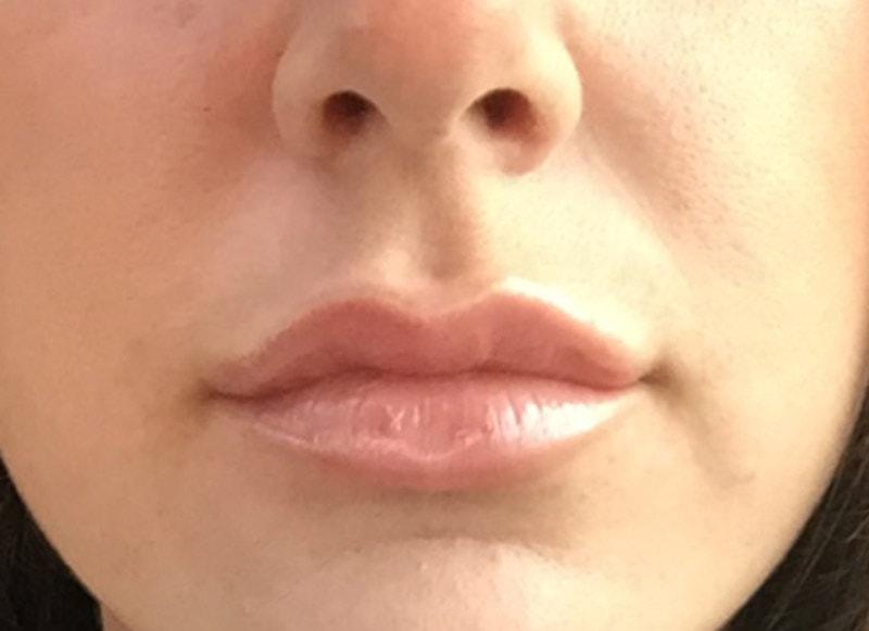 Neil Tanna, MD, FACS lip filler after — Great Neck, NY
