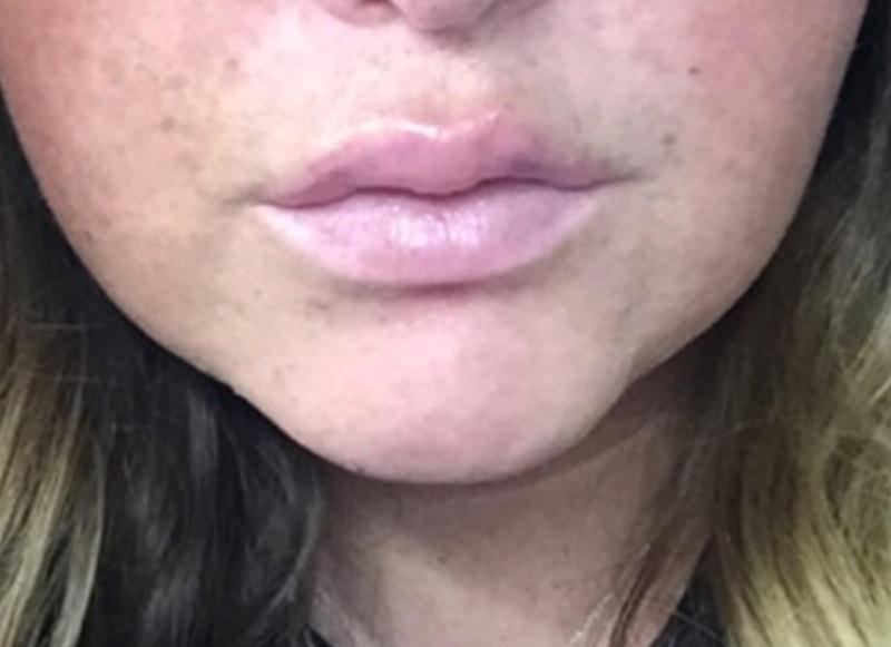 Neil Tanna, MD, FACS lip filler after — Great Neck, NY