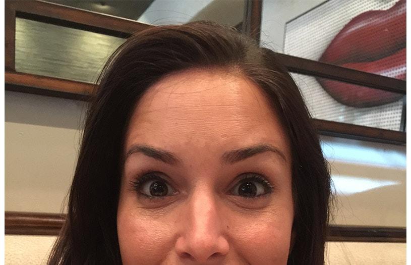 Neil Tanna, MD, FACS botox after — Great Neck, NY