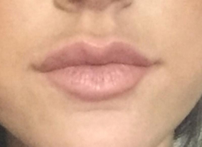 Neil Tanna, MD, FACS lip filler after — Great Neck, NY