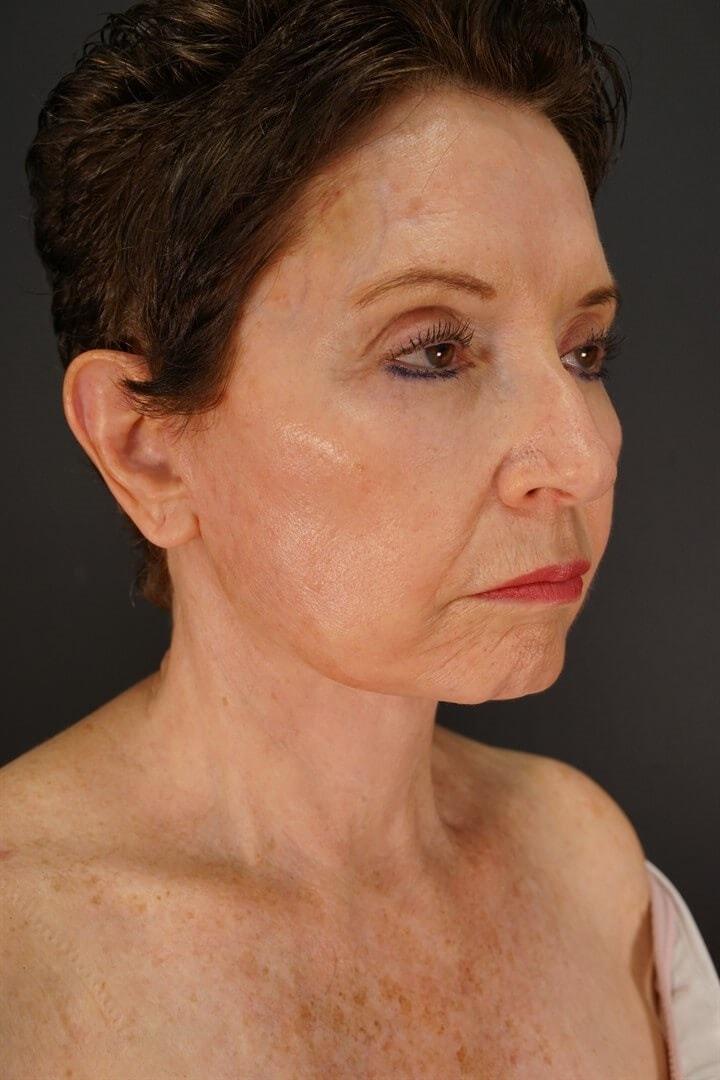 Urbaniak Plastic Surgery neck lift after — Largo, FL