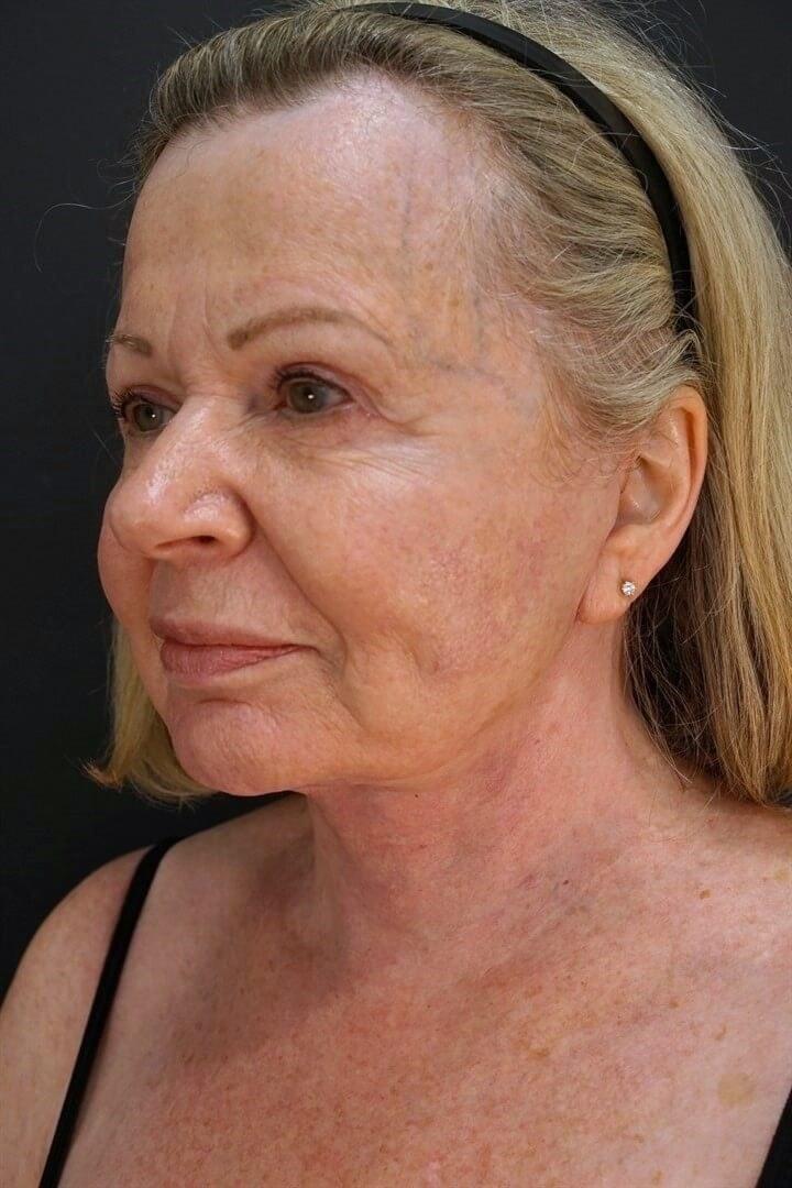 Urbaniak Plastic Surgery facelift after — Largo, FL