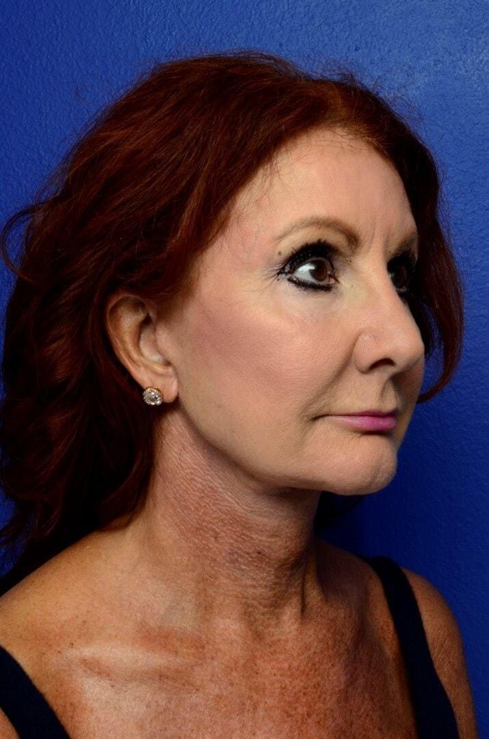 Urbaniak Plastic Surgery facelift after — Largo, FL