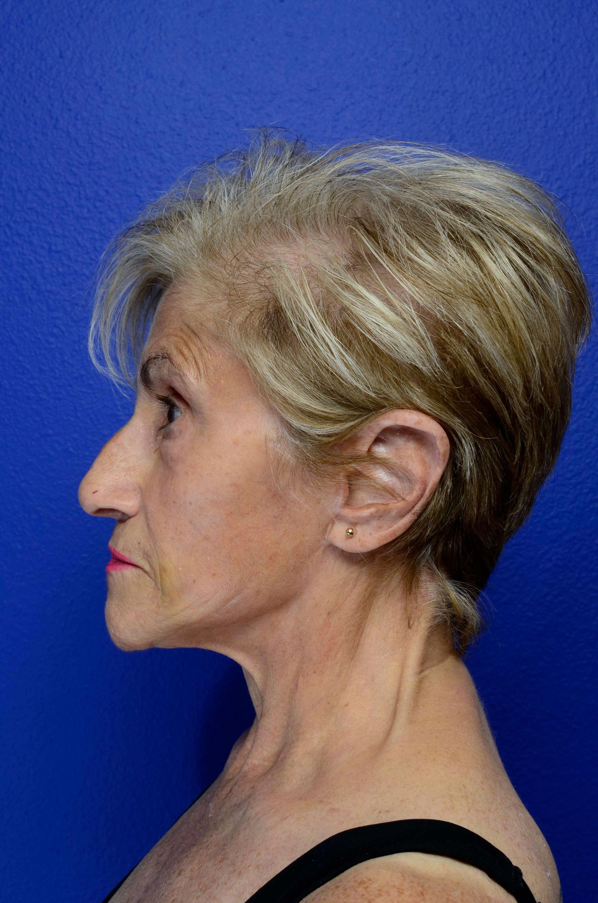 Urbaniak Plastic Surgery facelift after — Largo, FL