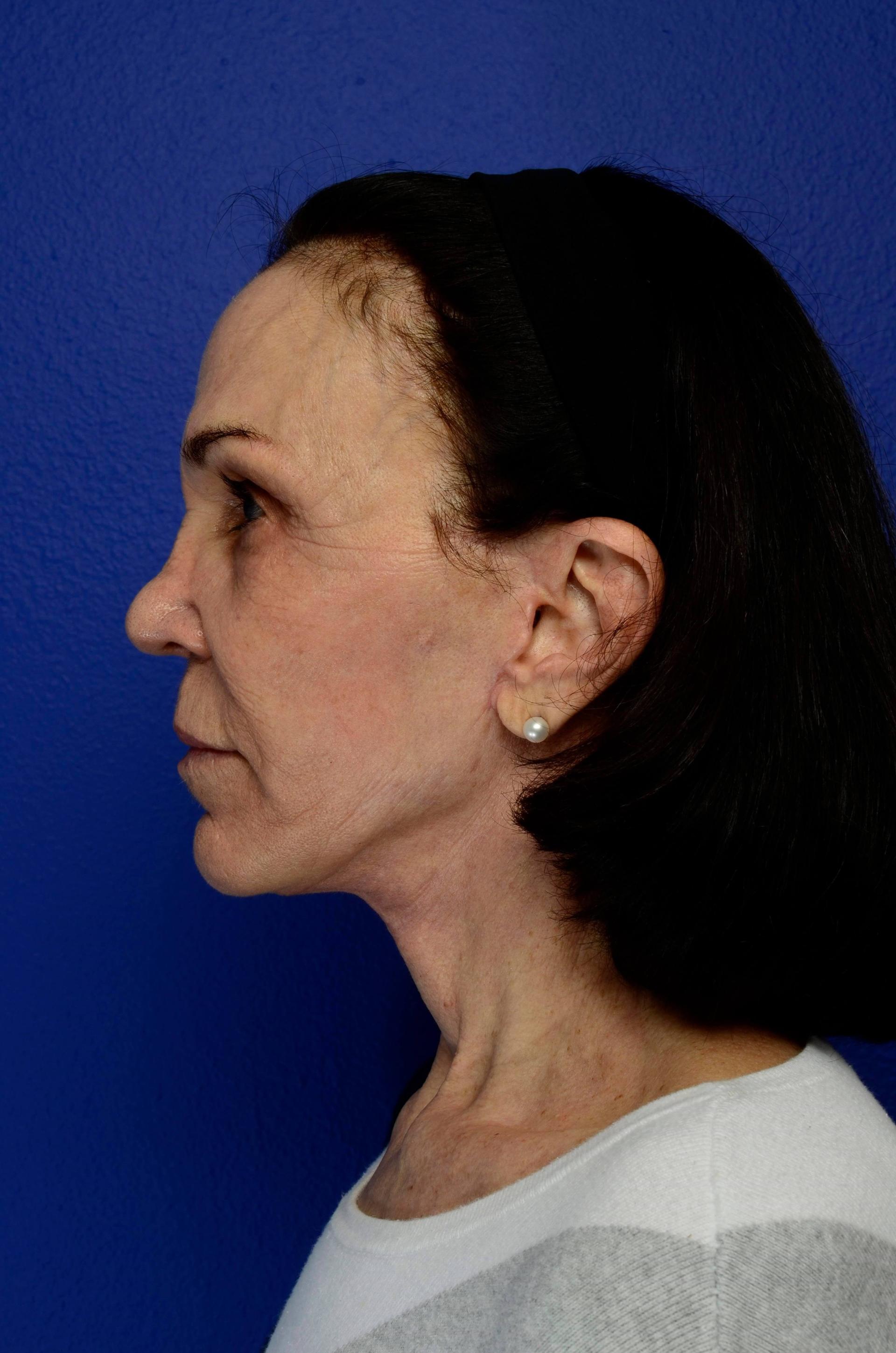 Urbaniak Plastic Surgery facelift after — Largo, FL