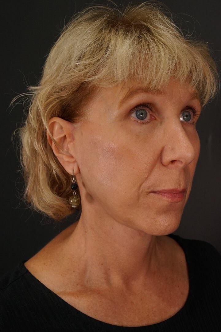 Urbaniak Plastic Surgery neck lift after — Largo, FL