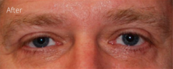 Lohner Plastic Surgery blepharoplasty result — Bryn Mawr, PA