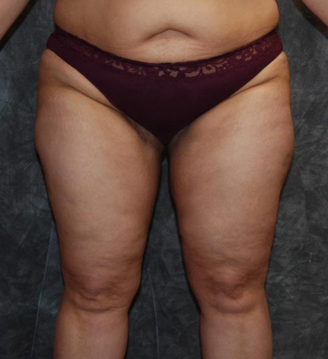 CoolSculpting after at Lohner Plastic Surgery in Bryn Mawr, PA