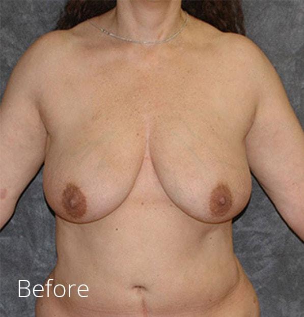 Breast Lift before at Lohner Plastic Surgery in Bryn Mawr, PA