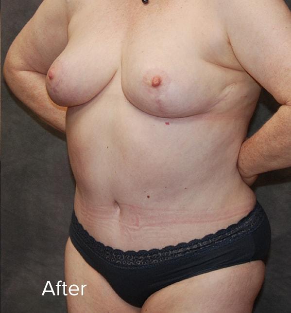 Mommy Makeover after at Lohner Plastic Surgery in Bryn Mawr, PA