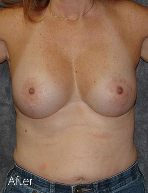 Breast Lift after at Lohner Plastic Surgery in Bryn Mawr, PA