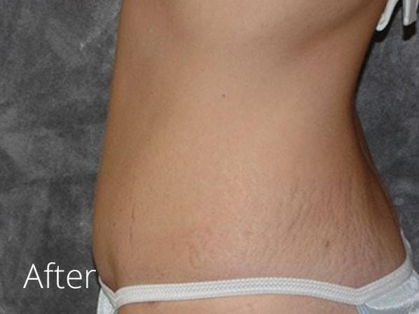 Lohner Plastic Surgery tummy tuck after — Bryn Mawr, PA