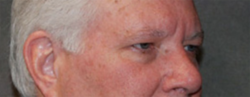 Lohner Plastic Surgery blepharoplasty result — Bryn Mawr, PA