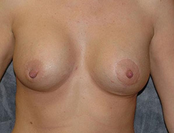 Breast Augmentation after at Lohner Plastic Surgery in Bryn Mawr, PA