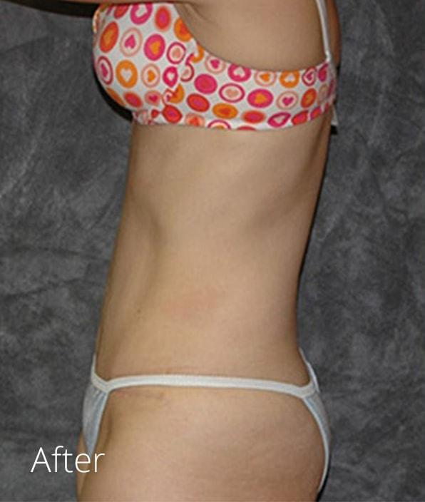 Mini Tummy Tuck after at Lohner Plastic Surgery in Bryn Mawr, PA