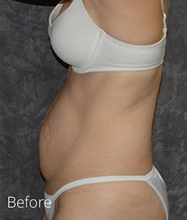 Mini Tummy Tuck before at Lohner Plastic Surgery in Bryn Mawr, PA