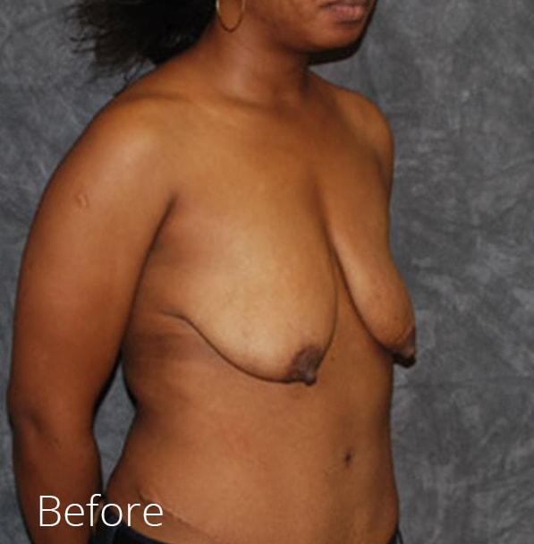 Breast Lift before at Lohner Plastic Surgery in Bryn Mawr, PA