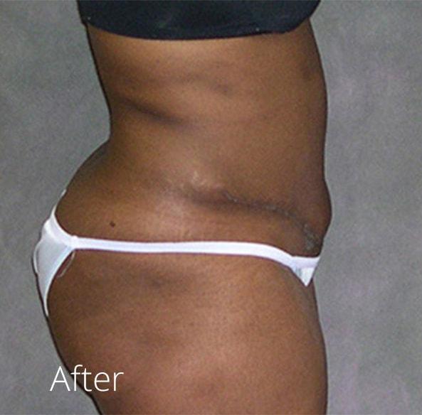 Lohner Plastic Surgery tummy tuck after — Bryn Mawr, PA