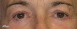 Lohner Plastic Surgery blepharoplasty result — Bryn Mawr, PA