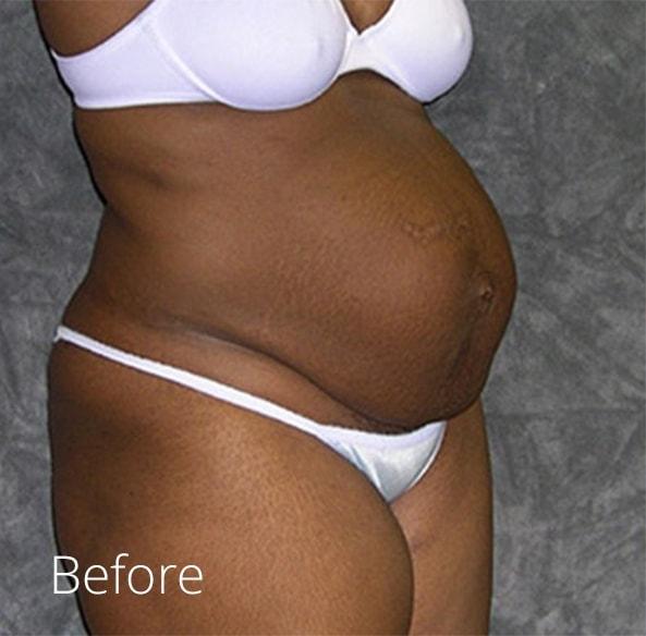 Mini Tummy Tuck before at Lohner Plastic Surgery in Bryn Mawr, PA