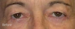 Lohner Plastic Surgery blepharoplasty result — Bryn Mawr, PA