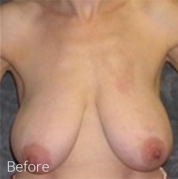 Breast Reduction before at Lohner Plastic Surgery in Bryn Mawr, PA