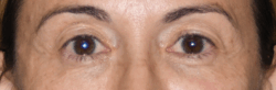 Blepharoplasty result at Lohner Plastic Surgery in Bryn Mawr, PA