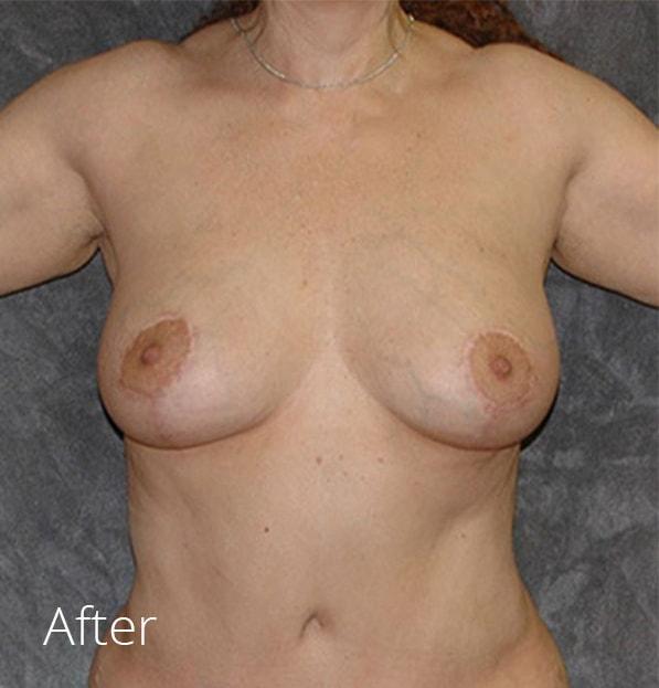 Breast Lift after at Lohner Plastic Surgery in Bryn Mawr, PA