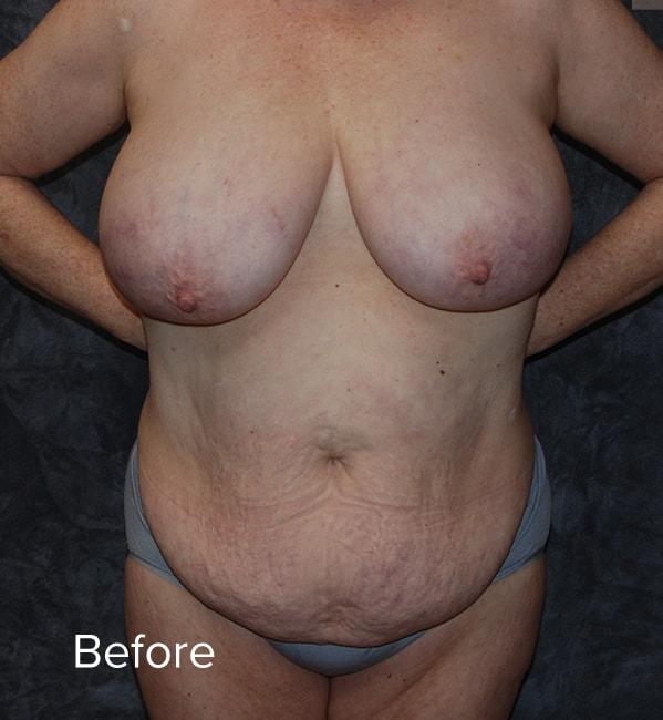 Mommy Makeover before at Lohner Plastic Surgery in Bryn Mawr, PA