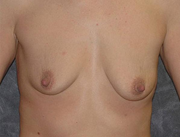 Breast Augmentation before at Lohner Plastic Surgery in Bryn Mawr, PA