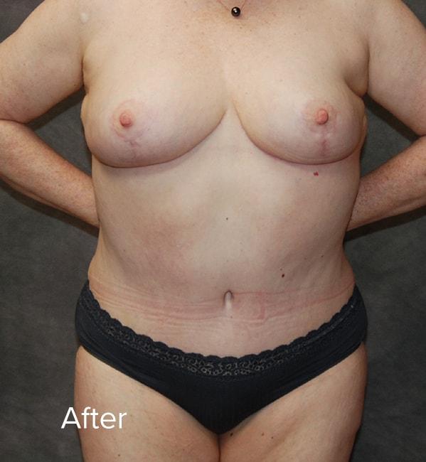 Mommy Makeover after at Lohner Plastic Surgery in Bryn Mawr, PA
