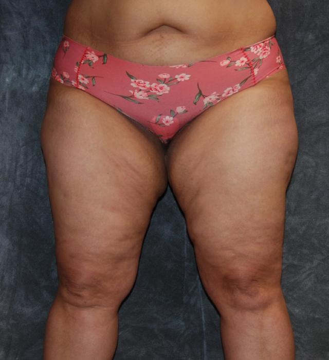 CoolSculpting before at Lohner Plastic Surgery in Bryn Mawr, PA