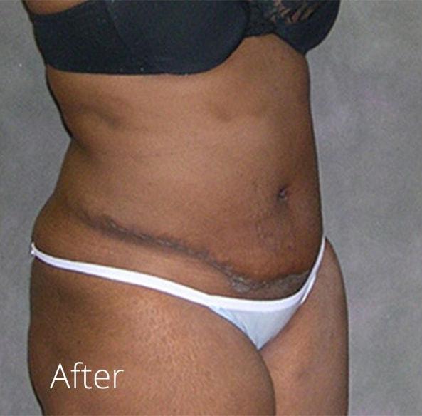 Mini Tummy Tuck after at Lohner Plastic Surgery in Bryn Mawr, PA