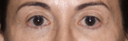 Blepharoplasty result at Lohner Plastic Surgery in Bryn Mawr, PA