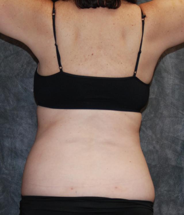 Liposuction after at Lohner Plastic Surgery in Bryn Mawr, PA