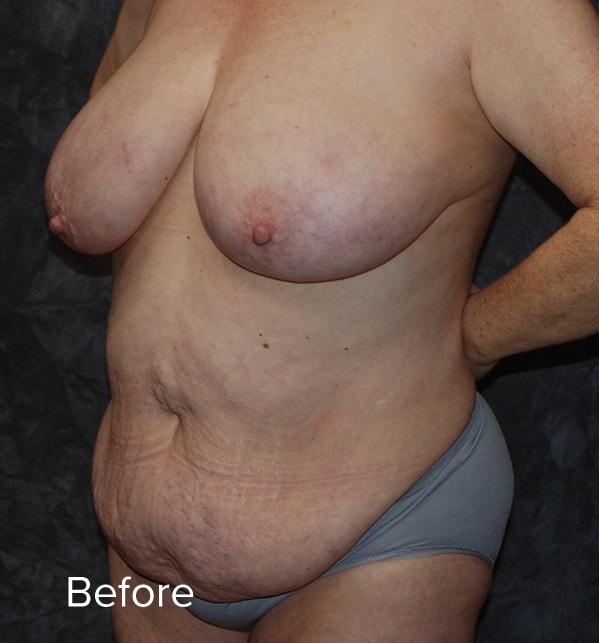 Mommy Makeover before at Lohner Plastic Surgery in Bryn Mawr, PA