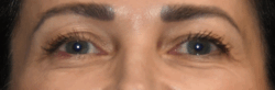 Blepharoplasty result at Lohner Plastic Surgery in Bryn Mawr, PA