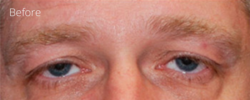 Lohner Plastic Surgery blepharoplasty result — Bryn Mawr, PA
