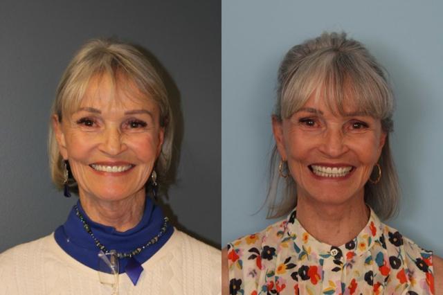 Facelift result at Faces First in Denver, CO
