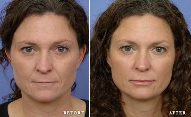 Botox result at Faces First in Denver, CO