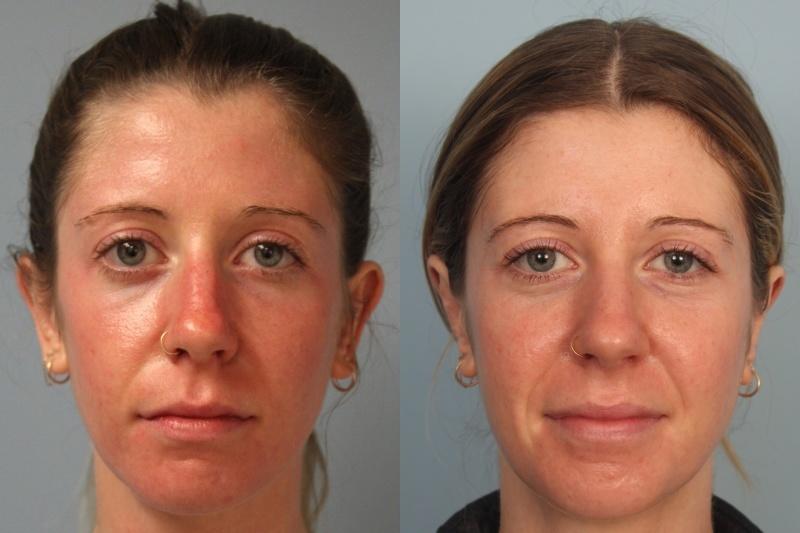 Faces First otoplasty result — Denver, CO