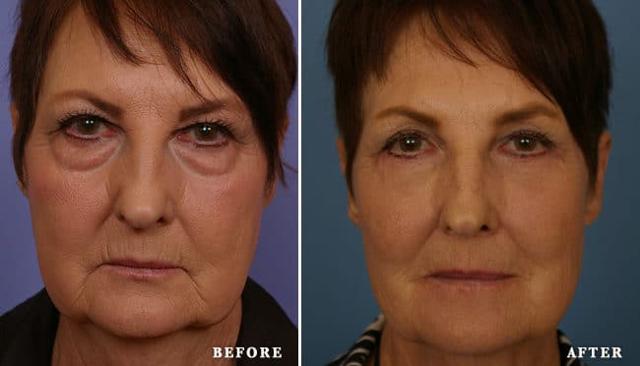 Fat Transfer result at Faces First in Denver, CO