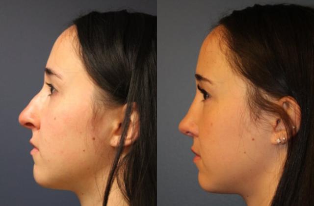 Functional Rhinoplasty result at Faces First in Denver, CO