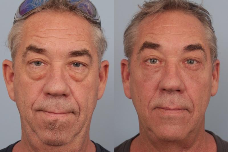 Faces First blepharoplasty result — Denver, CO