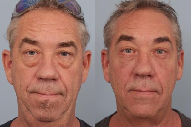 Blepharoplasty result at Faces First in Denver, CO