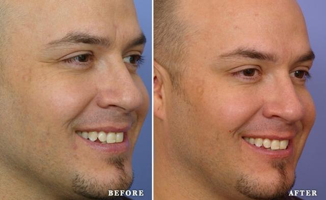 Botox result at Faces First in Denver, CO
