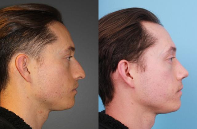 Functional Rhinoplasty result at Faces First in Denver, CO