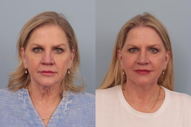 Facelift result at Faces First in Denver, CO