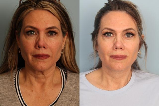 Facelift result at Faces First in Denver, CO