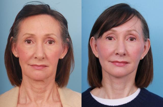 Mini Facelift result at Faces First in Denver, CO